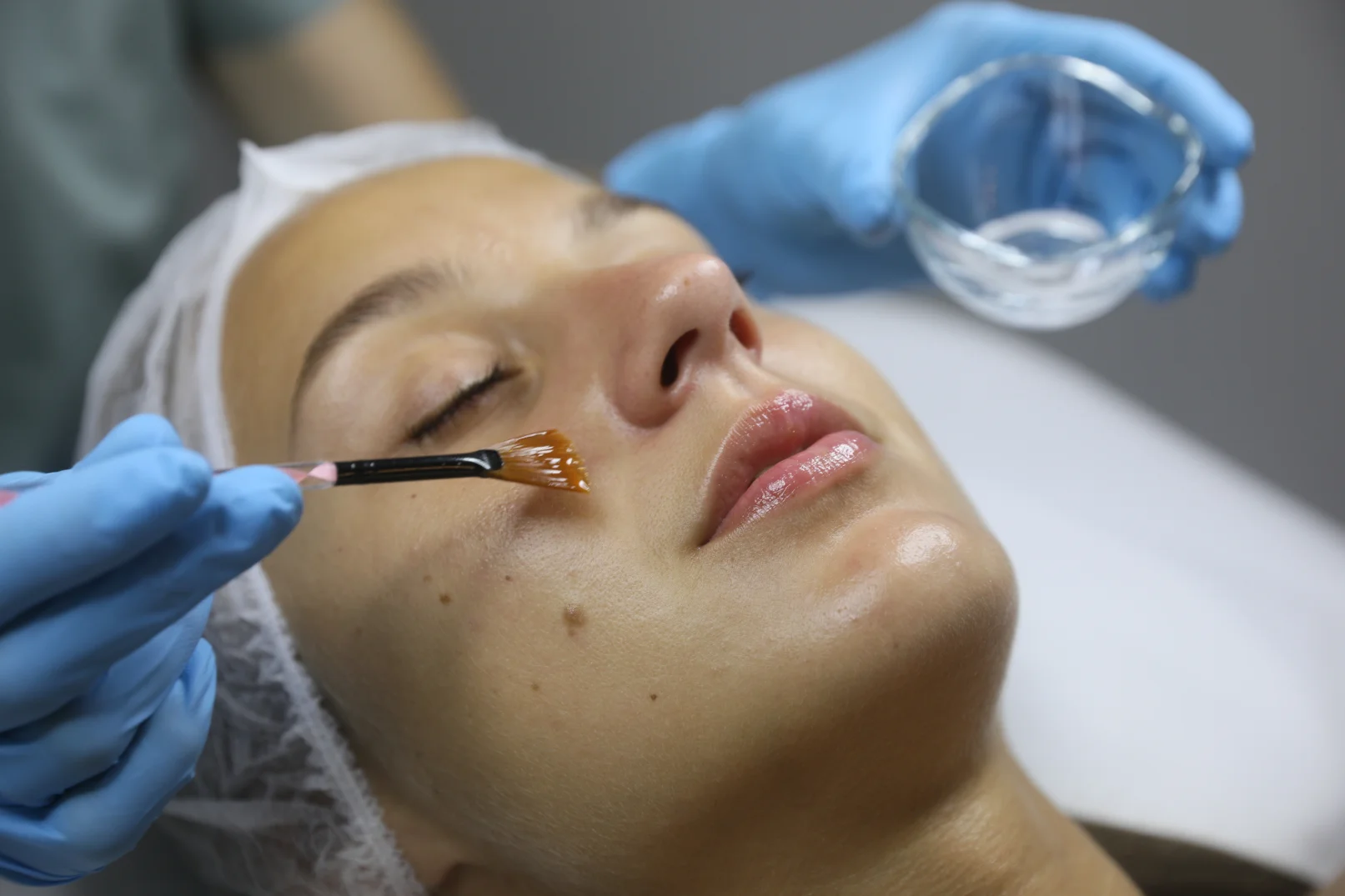 Chemical Peels in Roswell, GA 1 Chemical Peels
