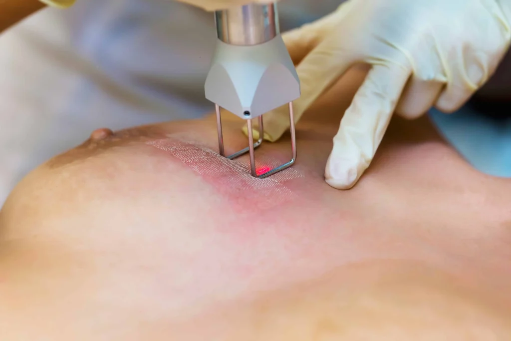 A woman removes Stretch marks