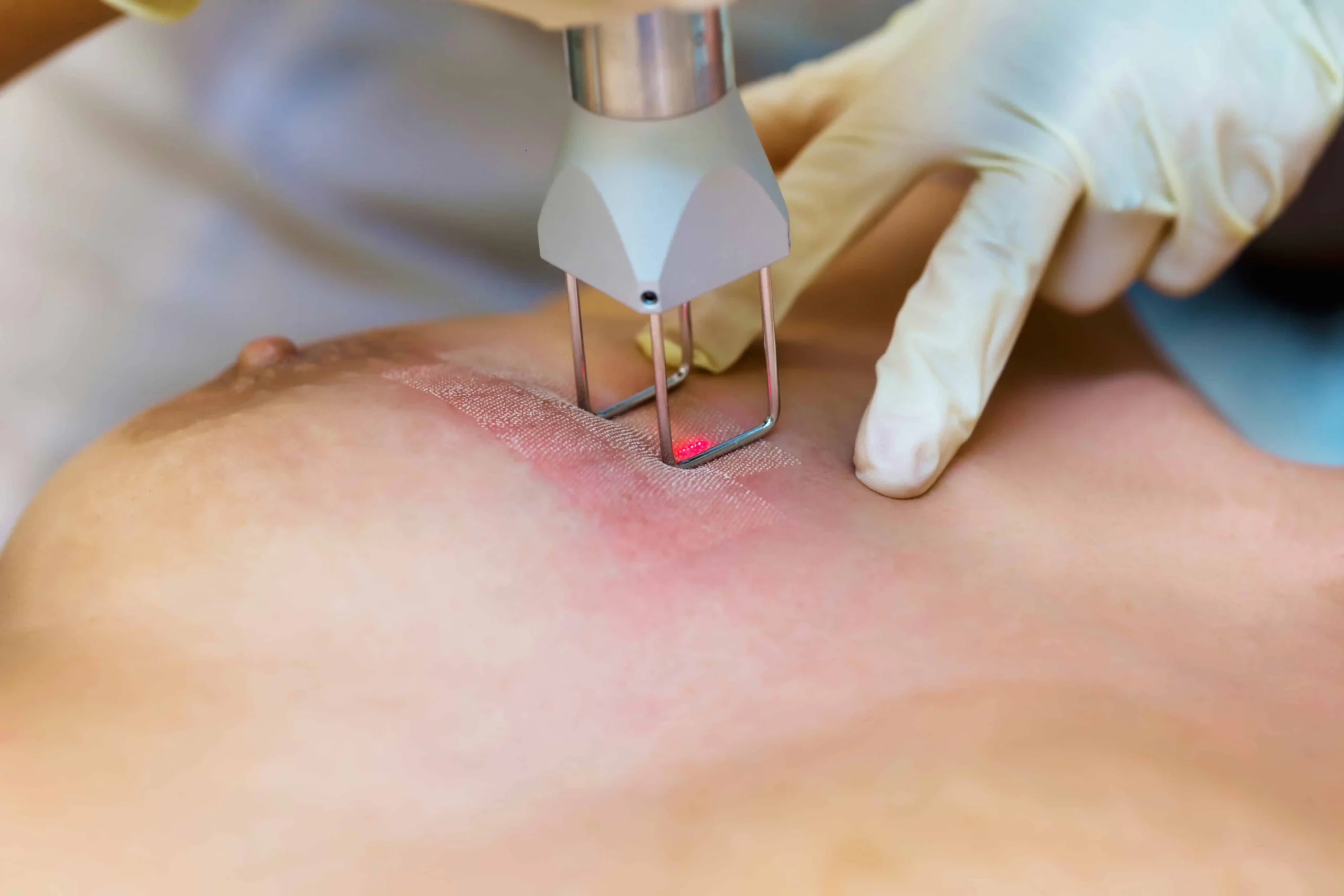 A woman removes Stretch marks