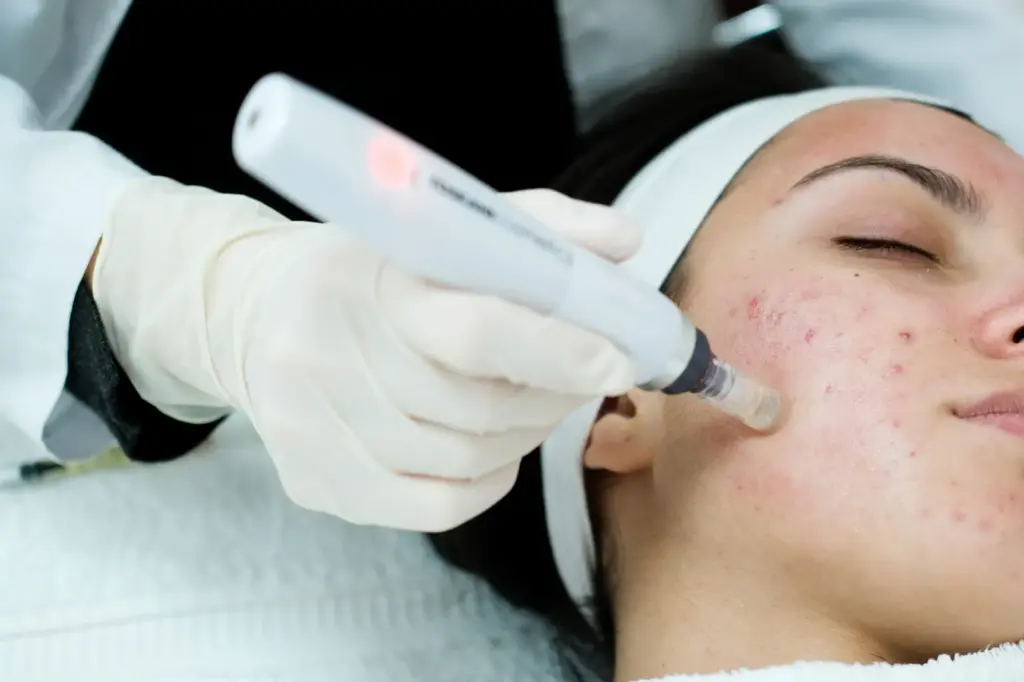 A woman taking Microneedling in Duluth, GA