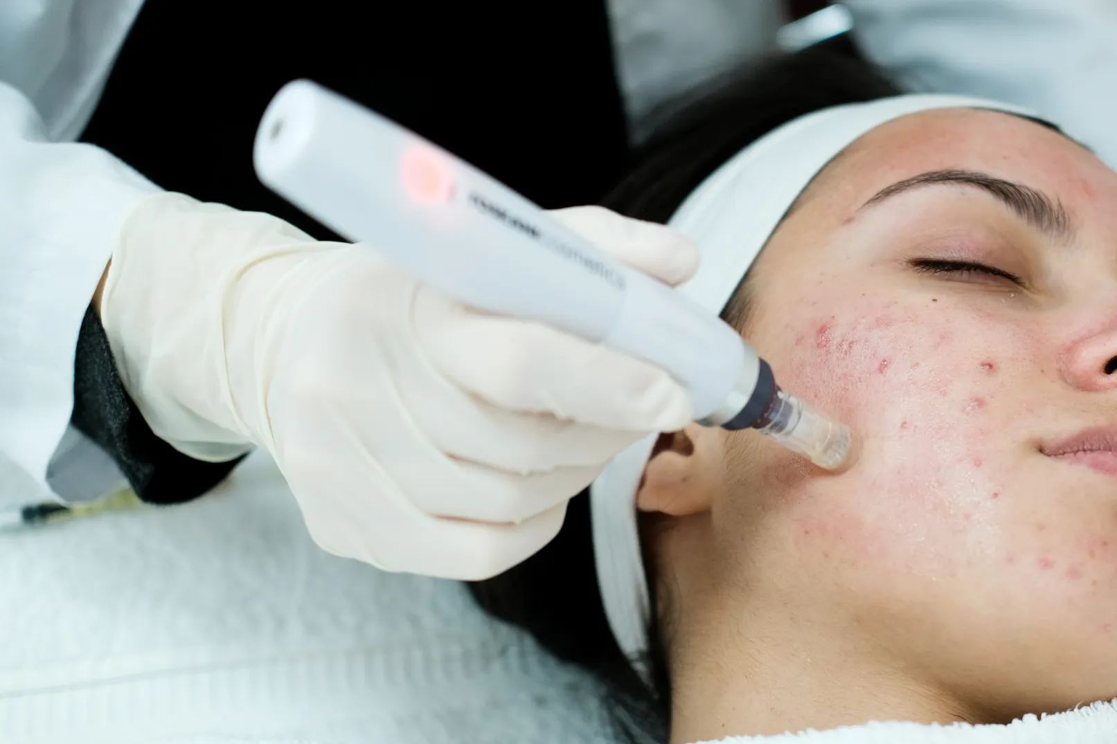 A woman taking Microneedling in Duluth, GA